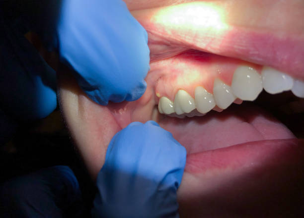 Best Emergency Treatment for Oral Infections in Trempealeau, WI